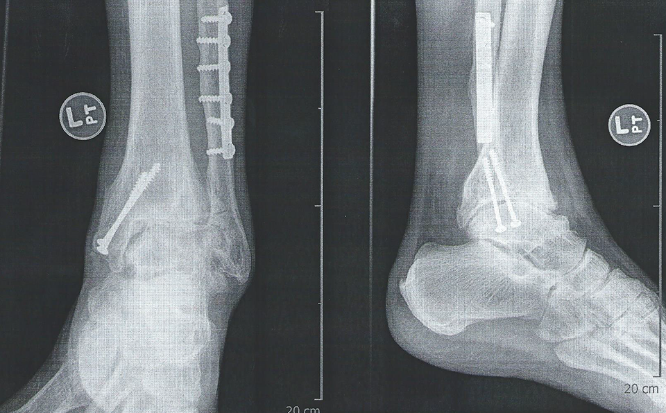 Ankle Arthritis Podiatrist Carlsbad Dr. Keenan Carriero DPM