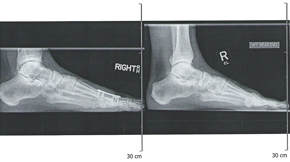 Hallux Rigidus | Podiatric Surgery Carlsbad | Dr. Keenan Carriero DPM ...