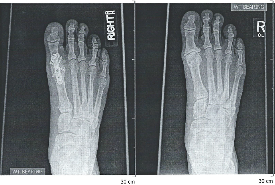 Big toe arthritis
