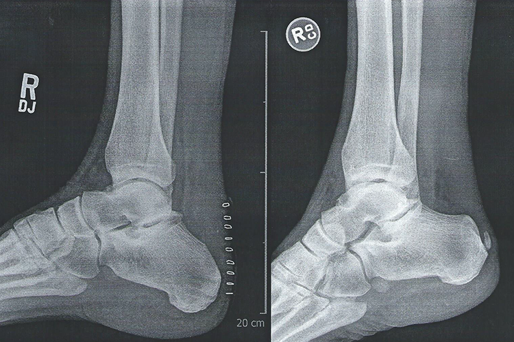 Haglund's Deformity