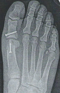 Bunion correction