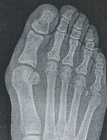 Bunion hallux valgus