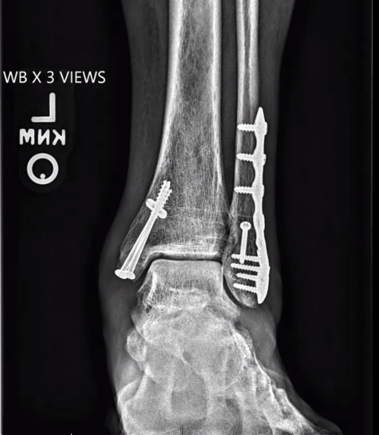 ankle fracture