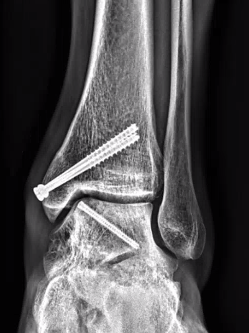 Osteochondral lesion OATS