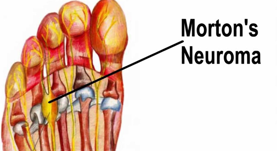 Morton Neuroma Is An Injury To The Nerve Between The Toes, Which Causes ...